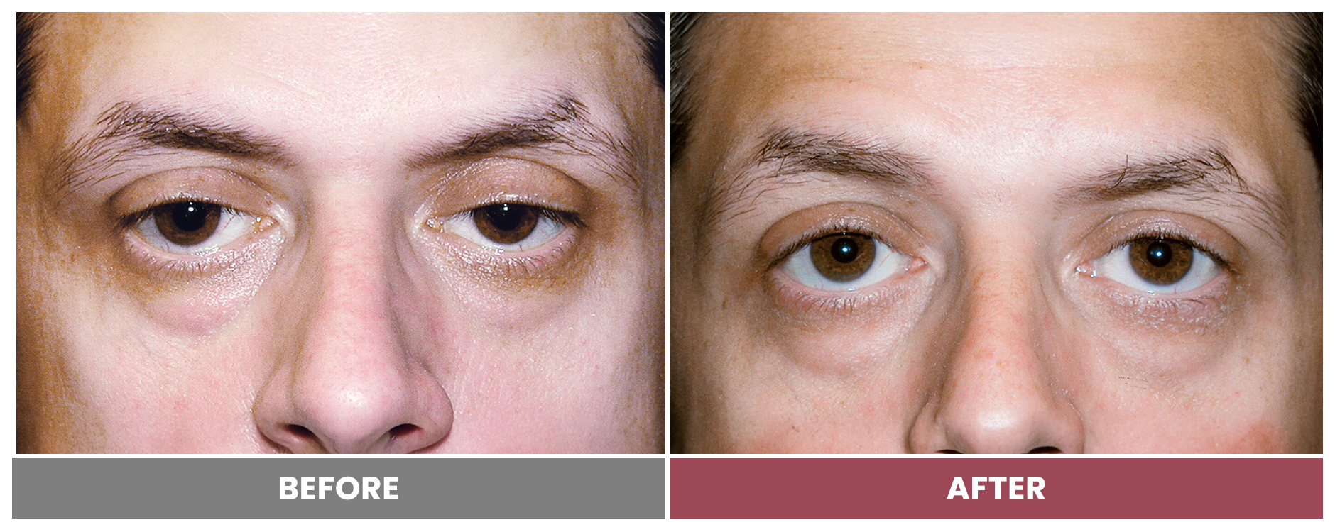 PTOSIS REPAIR - Case 7